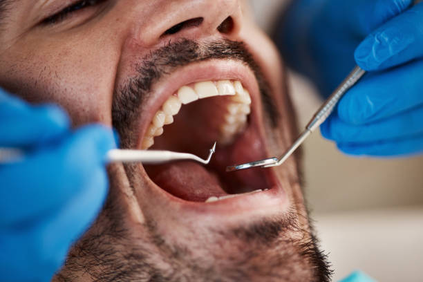 Best Emergency Wisdom Teeth Removal in College Place, WA
